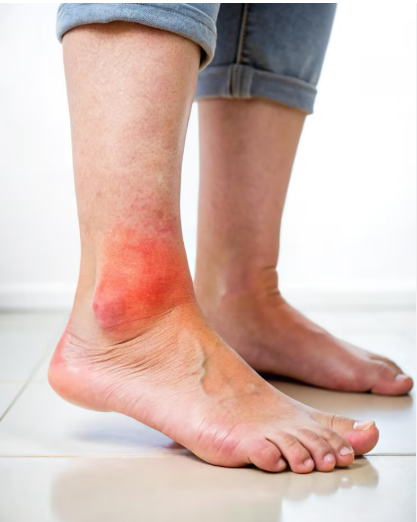  Swelling